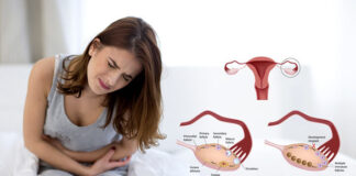 (PCOS) Polycystic ovary syndrome symptoms and causes
