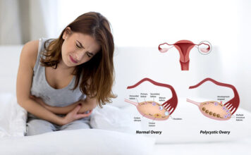 (PCOS) Polycystic ovary syndrome symptoms and causes (PCOS) Polycystic ovary syndrome symptoms and causes