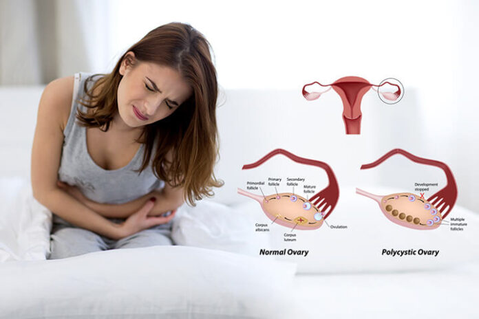 (PCOS) Polycystic ovary syndrome symptoms and causes