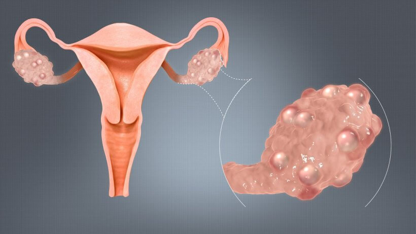 what is PCOS?