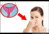 Vaginal odor : Why does my discharge smell bad? Causes of vaginal odor