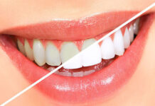 Teeth whitening