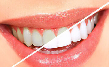 TEETH WHITENING TREATMENT: AT HOME OR AT THE CLINIC? Teeth whitening