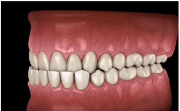 Underbite