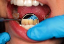 dental tartar