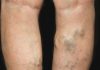 Natural Varicose Vein Remedies Varicose Vein