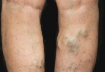 Varicose Vein