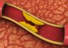 Symptoms and tips to raise HDL cholesterol levels HDL cholesterol levels