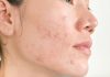 5 Causes of Adult Acne and How to Treat It adult acne