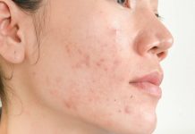 adult acne