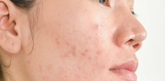 adult acne