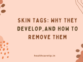 Skin Tags: Why They Develop and How to Remove Them Safely