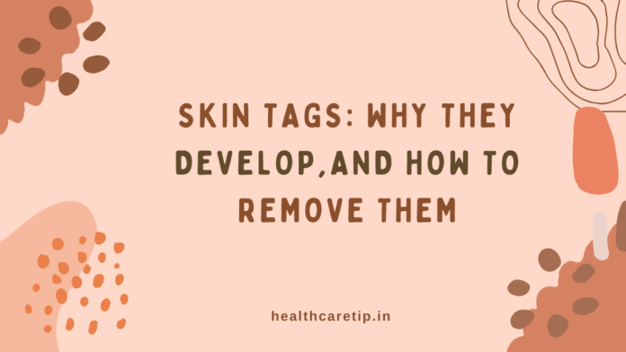 Skin Tags: Why They Develop and How to Remove Them Safely